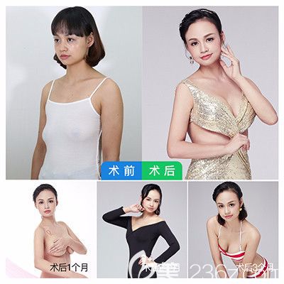 廣州曙光吳毅平隆胸案例效果圖 廣州曙光吳毅平隆胸案例效果圖