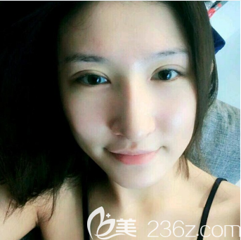 佛山華美雷朝勇雙眼皮案例7天自拍