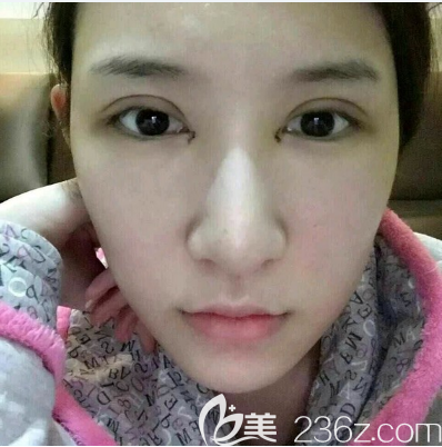 雷朝勇做過的雙眼皮案例術(shù)后三天