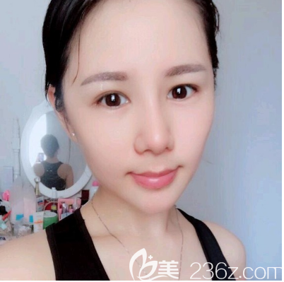 佛山華美雷朝勇肋軟骨隆鼻案例 佛山華美雷朝勇肋軟骨隆鼻案例