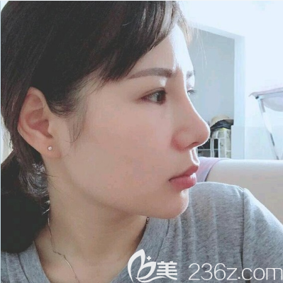 雷朝勇做的隆鼻案例一個(gè)月側(cè)面效果圖 雷朝勇做的隆鼻案例一個(gè)月側(cè)面效果圖