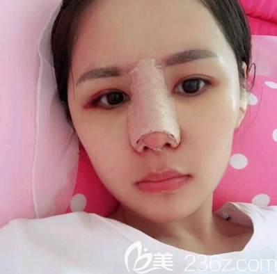 佛山華美肋軟骨隆鼻術(shù)后天 佛山華美肋軟骨隆鼻術(shù)后天