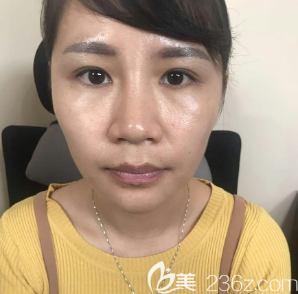 去佛山華美走隆鼻手術(shù)術(shù)前照片 去佛山華美走隆鼻手術(shù)術(shù)前照片