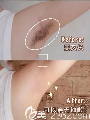 冰點脫腋毛真人前后效果展示