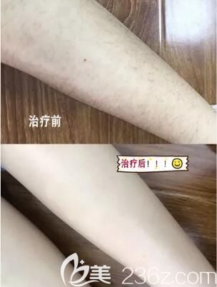 冰點脫腿毛真人前后展示