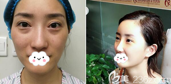 綿陽朗睿整形<!--<i data=20240703-sp></i>-->耳軟骨隆鼻案 綿陽朗睿整形<!--<i data=20240703-sp></i>-->耳軟骨隆鼻案