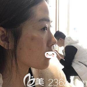 鄭州華領(lǐng)全面部PPDO<span style= 鄭州華領(lǐng)全面部PPDO<span style=