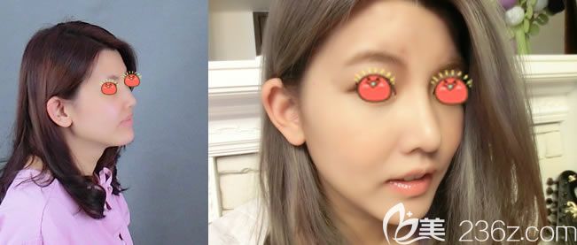 東陽麗萊楊建榮鼻綜合隆鼻案例 東陽麗萊楊建榮鼻綜合隆鼻案例