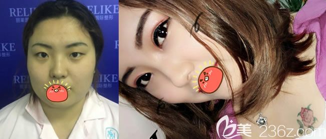 東陽麗萊<!--<i data=20240703-sp></i>-->割雙眼皮和開眼角案例 東陽麗萊<!--<i data=20240703-sp></i>-->割雙眼皮和開眼角案例