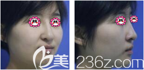 我在北京雅靚做鼻修復(fù)前樣子 我在北京雅靚做鼻修復(fù)前樣子