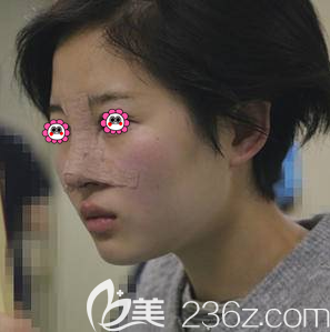 陳林葉醫(yī)生給我鼻修復(fù)術(shù)后即刻樣子 陳林葉醫(yī)生給我鼻修復(fù)術(shù)后即刻樣子