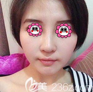 在北京雅靚做鼻修復(fù)第17天效果 在北京雅靚做鼻修復(fù)第17天效果