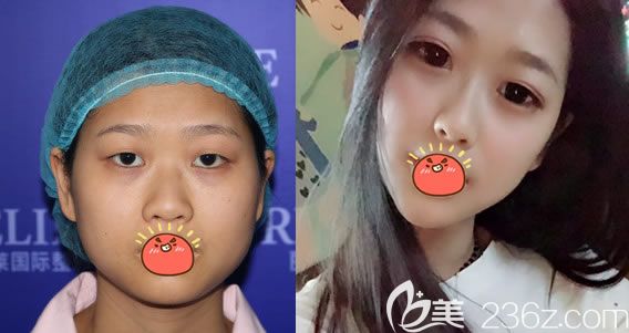 東陽麗萊楊建榮雙眼皮開眼角案例 東陽麗萊楊建榮雙眼皮開眼角案例