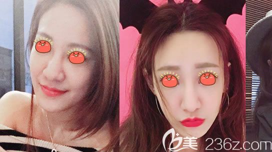 東陽(yáng)橫店麗萊<!--<i data=20240703-sp></i>-->麗瘦臉案例 東陽(yáng)橫店麗萊<!--<i data=20240703-sp></i>-->麗瘦臉案例