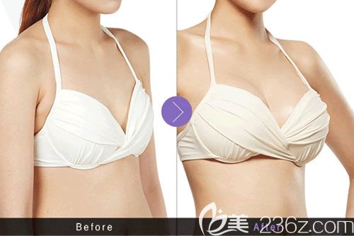 東陽麗萊沈干院長隆胸案例 東陽麗萊沈干院長隆胸案例