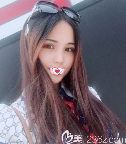 一起來看單眼皮+上瞼下垂的我在做完眼綜合術(shù)后的效果怎么樣