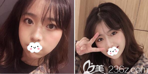 雷剛自體脂肪填充面部術(shù)后3個月恢復(fù)照片