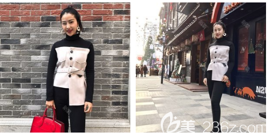 廣州藝美寶麗太大腿吸脂10天消腫 廣州藝美寶麗太大腿吸脂10天消腫