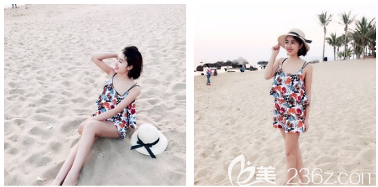 廣州藝美張濤做的寶麗太大腿吸脂案例 廣州藝美張濤做的寶麗太大腿吸脂案例