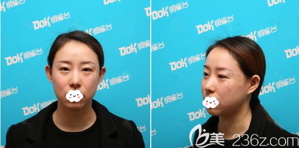 激光祛斑治療前臉上雀斑嚴(yán)重 激光祛斑治療前臉上雀斑嚴(yán)重