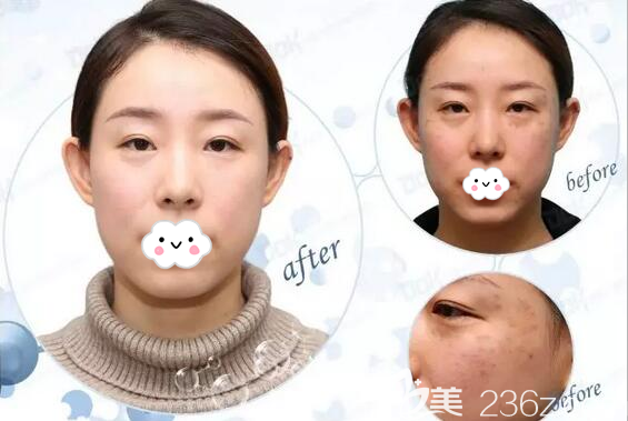 雷國(guó)婕水動(dòng)能祛斑前后對(duì)比照片 雷國(guó)婕水動(dòng)能祛斑前后對(duì)比照片