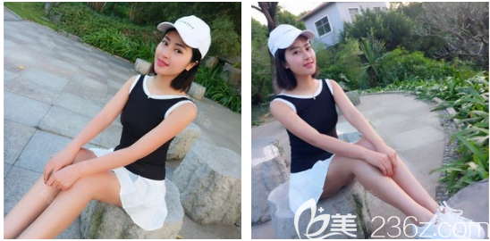 我在廣州藝美找張濤做完寶麗太大腿吸脂才10天就消腫恢復(fù)正常了