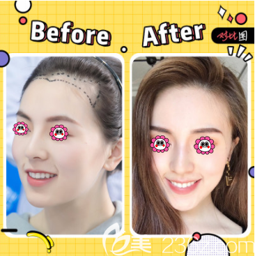 北京碧蓮盛楊志祥醫(yī)生發(fā)際線種植案例