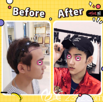 北京碧蓮盛陳彪醫(yī)生鬢角+發(fā)際線種植案例