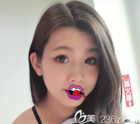 東陽橫店麗萊整形做隆鼻前 東陽橫店麗萊整形做隆鼻前