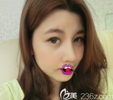 橫店麗萊整形隆鼻案例14天效果 橫店麗萊整形隆鼻案例14天效果