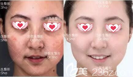 大連沙醫(yī)生整形美容醫(yī)院嫩膚煥膚真人前后效果對(duì)比