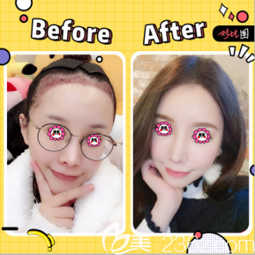 北京碧蓮盛袁國(guó)安醫(yī)生發(fā)際線種植案例