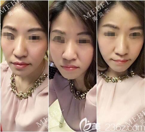 杜瑞分享線雕+脂肪填充術(shù)后20天恢復(fù) 杜瑞分享線雕+脂肪填充術(shù)后20天恢復(fù)