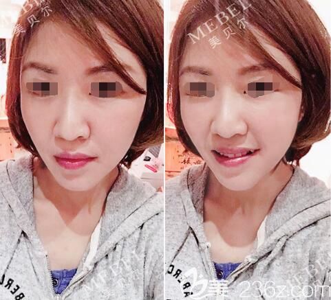 面部松弛+法令紋+額頭扁平面診過南京美貝爾杜瑞醫(yī)生定制線雕+脂肪填充提升面部掩藏年齡