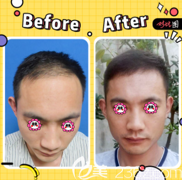 北京碧蓮盛陳彪醫(yī)生頭頂加密種植案例