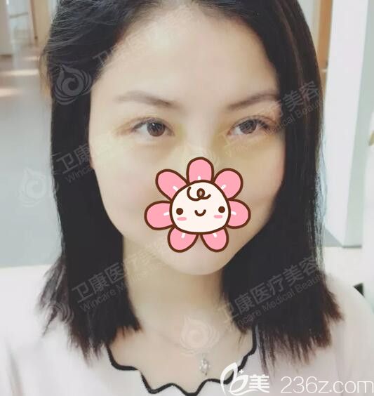 術(shù)后一周到蘇州衛(wèi)康拆線(xiàn)后雙眼皮恢復(fù)