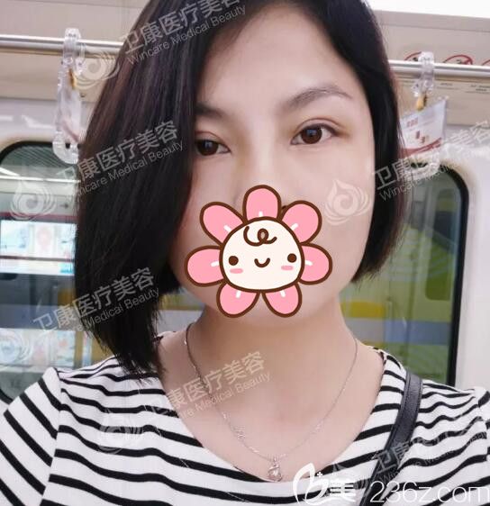 再三對比蘇州有排名的整形醫(yī)院后選定了蘇州衛(wèi)康李景方醫(yī)生做雙眼皮，8mm寬度很適合