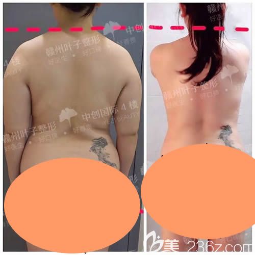 贛州葉子整形吸脂前后對比圖