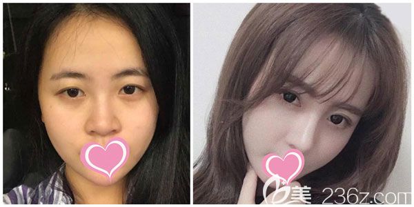 胡凱做假體隆鼻+肋軟骨隆鼻效果對比圖