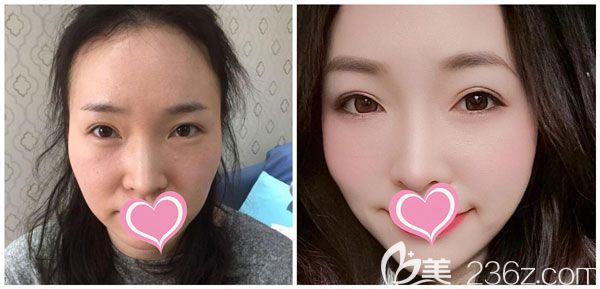 李成龍做面部線雕提升效果對比圖