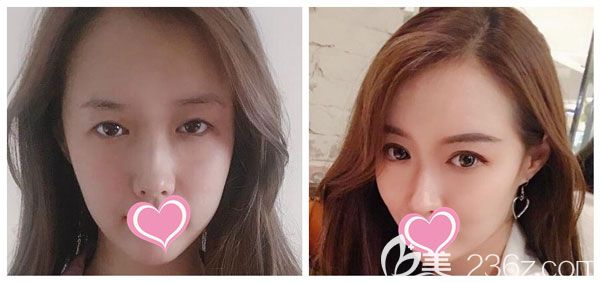 做眼綜合+全切雙眼皮效果對比圖