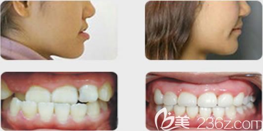 福州維樂郭淑蘋地包天牙齒矯正前后對比效果 福州維樂郭淑蘋地包天牙齒矯正前后對比效果