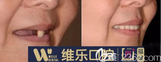 陳獻(xiàn)禮醫(yī)生全口種植牙對比圖 陳獻(xiàn)禮醫(yī)生全口種植牙對比圖