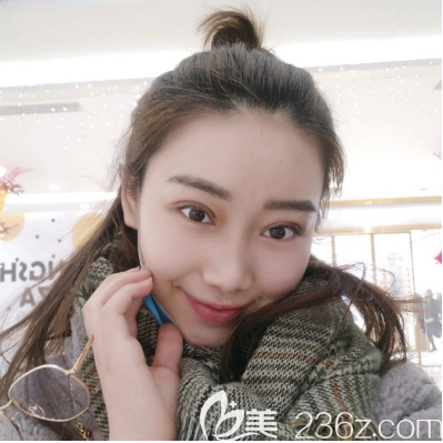 汕頭華美雙眼皮案例15天效果圖