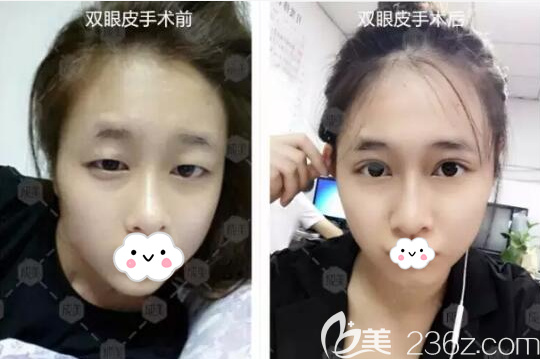 成都整形羅榮懷雙眼皮術(shù)前術(shù)后對(duì)比照片