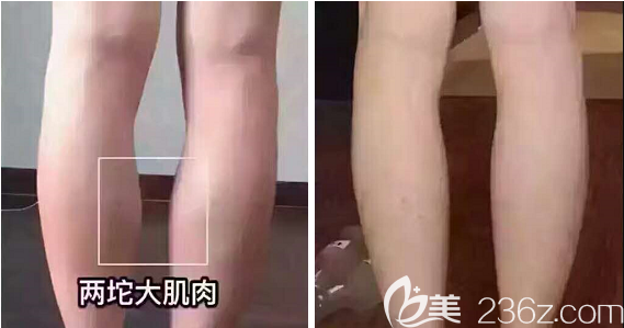 成都美容整形醫(yī)院瘦腿術(shù)后效果