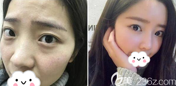 成美整形張莉線雕隆鼻術(shù)后效果