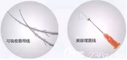 可吸收懸吊線和美容埋置線示意圖