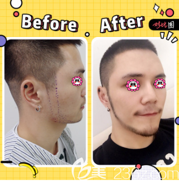 北京碧蓮盛魯少康醫(yī)生絡(luò)腮胡種植案例