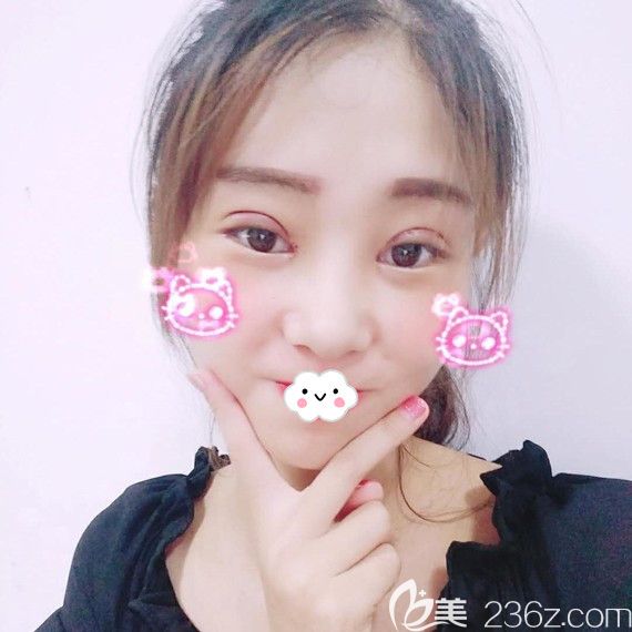 黃石中愛萬文勇雙眼皮+開內(nèi)眼角術(shù)后效果
